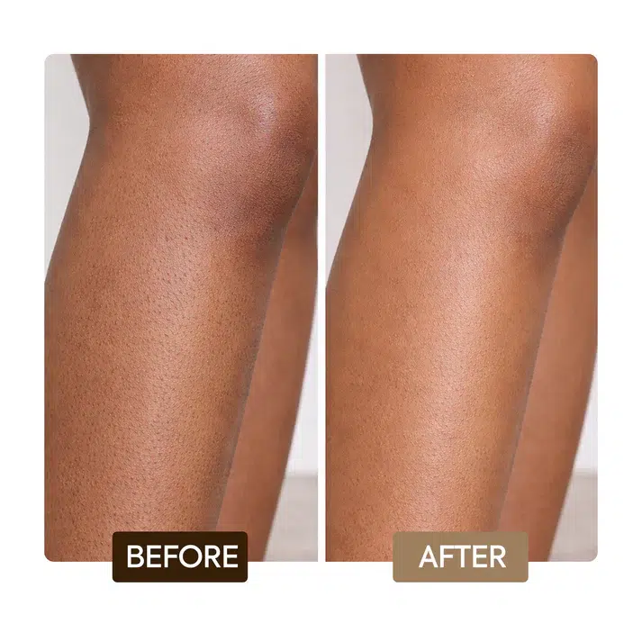 Comparaison côte à côte d'une jambe avant et après l'utilisation de DODIE Lot de 2 Tétines Rondes Vitesses Débit 4 Liquide Épais : le côté "avant" est bosselé et texturé, tandis que le côté "après" apparaît plus lisse et plus uniforme. Dakar