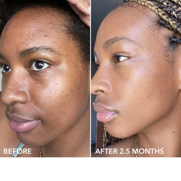 Photos côte à côte du visage d'une femme. À gauche : « Avant », sa peau est irrégulière. À droite : « Après 2,5 mois d'utilisation du Traitement à l'Acide Mandélique Anti-Imperfections The Inkey 15 ml », sa peau paraît plus lisse, plus nette et plus uniforme. Dakar