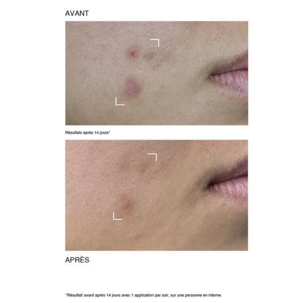 Le gros plan d'une joue montre des taches d'acné dans l'image "avant" et une peau plus claire après 14 jours d'utilisation de Payot Sérum Peeling Rénovateur Visage Peaux Grasses à Imperfections 30ml, illustrant une amélioration visible. Dakar