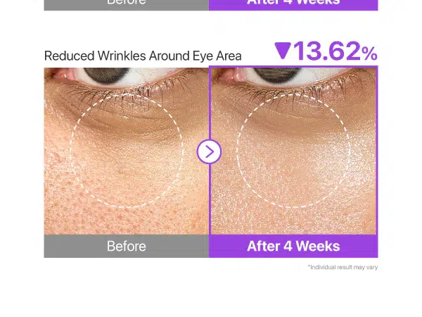 Photos côte à côte en gros plan de la peau du dessous des yeux : À gauche, des rides plus visibles avant le traitement ; à droite, une réduction de 13,62 % des rides après 4 semaines d'utilisation de Numbuzin Essence Anti Rides No.9 NAD Bio Lifting Essence 50 ml. Dakar