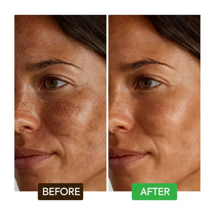 Gros plan côte à côte du visage d'une femme montrant "Avant" avec des taches sombres et un teint inégal, et "Après" avec un teint plus clair et plus uniforme. Des étiquettes indiquent la transformation. Dakar