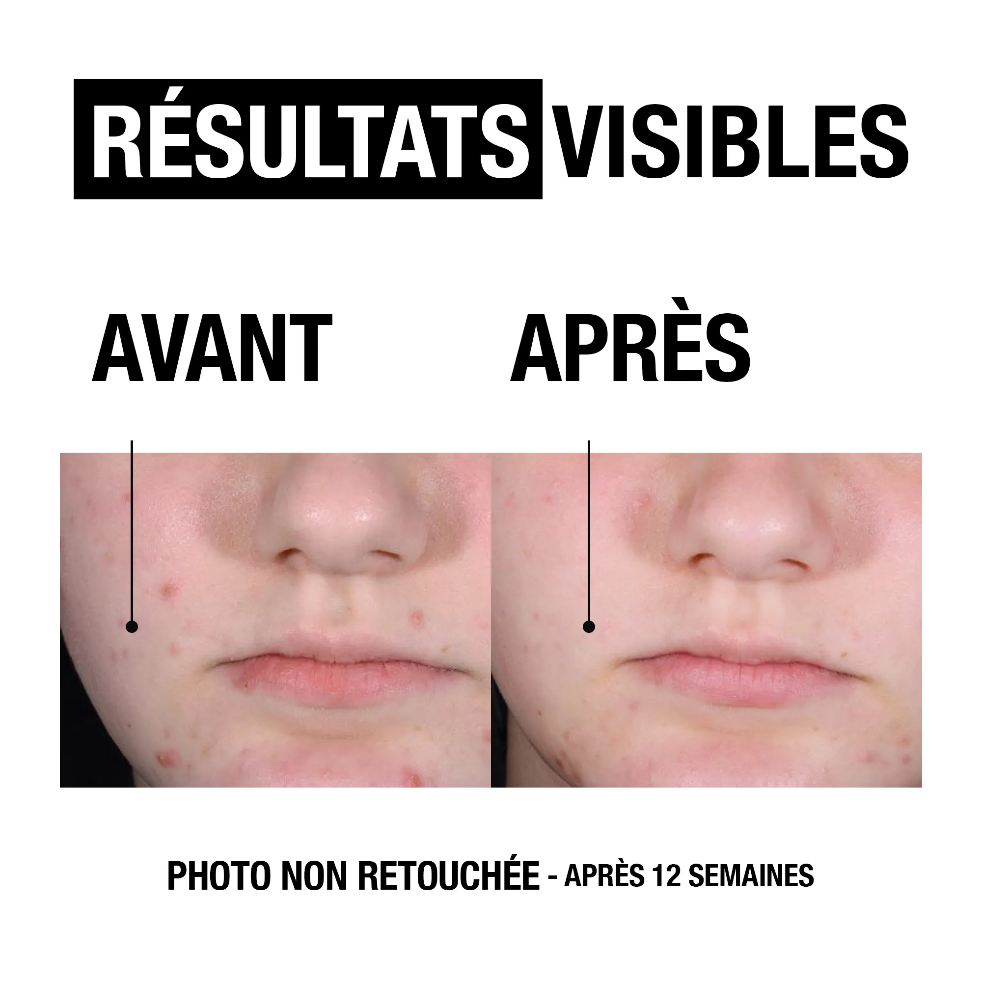 Comparaison de la partie inférieure du visage : à gauche « AVANT » avec des imperfections, à droite « APRÈS » avec une peau plus nette après 12 semaines d'utilisation du Soin Liquide Exfoliant Salicylique Peau Lisse de Garnier Skin Active, 120 ml. Le texte en français met en avant les « Résultats Visibles ». Dakar